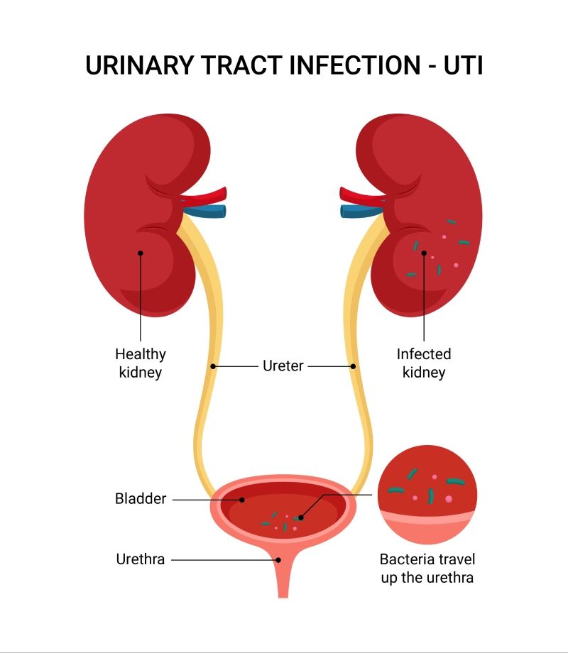UTI